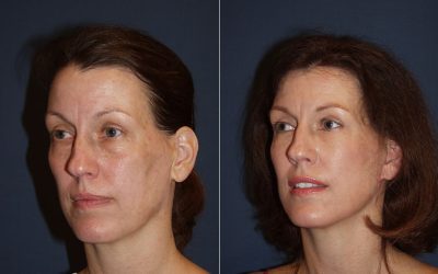 Lower Lid “SOOF” Lift blepharoplasty in Charlotte and the different variations